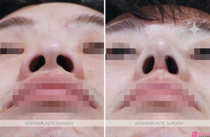 Q. Can a large nose be improved with nasal bridge osteotomy and tip surgery? (Question about male rhinoplasty before and after) image 5