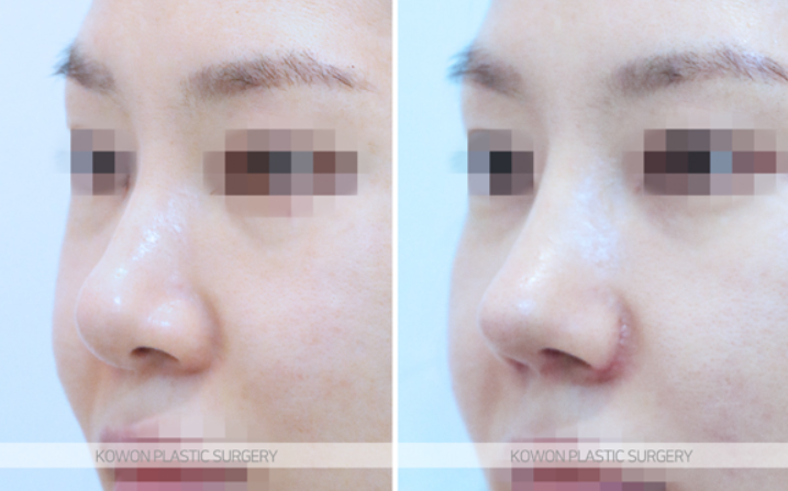 Q. 고민 about alar base surgery: do the nostrils need shape correction? image 3