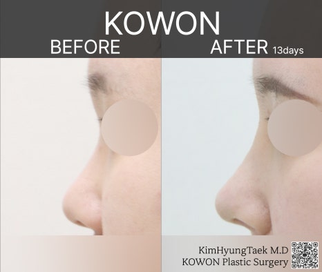 I Was Reborn with Small, Bulbous Nose Correction and Functional Nose Surgery for Deviated Septum at Kowon Plastic Surgery image 16