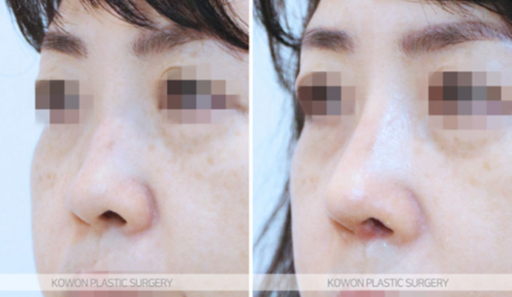Q. I’m considering nose surgery in Seoul, and I have questions about the methods and safety of rhinoplasty image 6