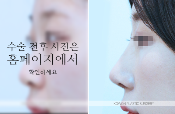 비순각교정 VS 단순 코높임 차이점과 회복에 대하여 관련 이미지 8