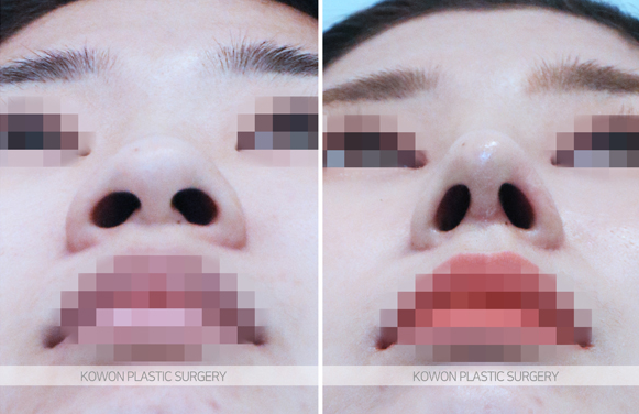 Q. Nasal Bone Fracture Rhinoplasty: Can I Correct a Crooked Nose and Raise the Bridge Even Though It’s Broken? image 3