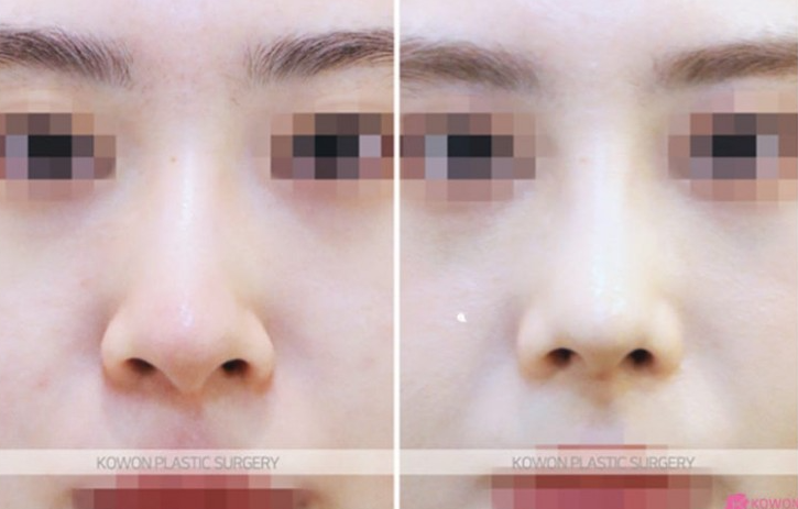 Q. Is non-open nose surgery possible? A complete guide to concerns about general anesthesia image 9