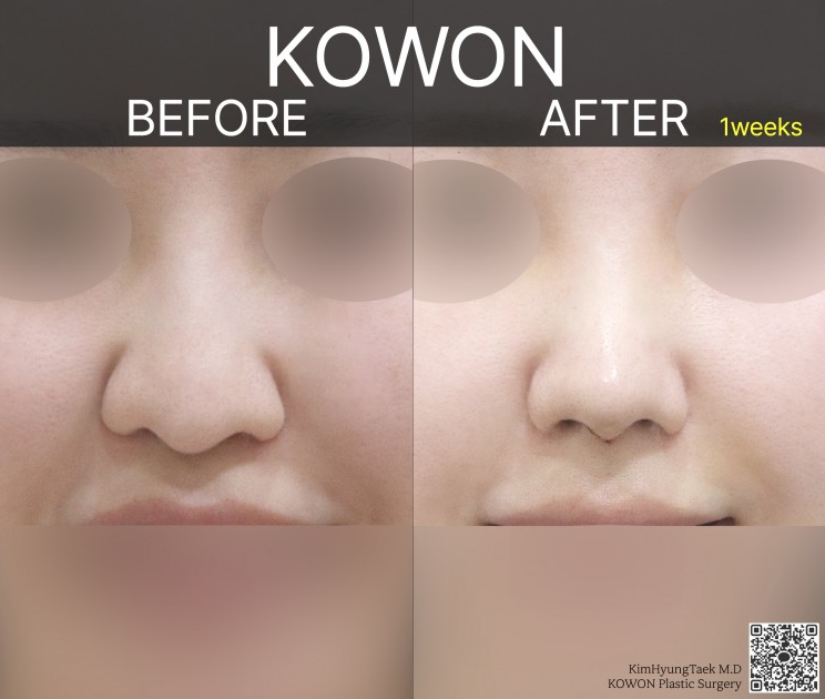 Q. After tip rhinoplasty with ear cartilage nose surgery, when does the pain from touching the nose become better? image 3