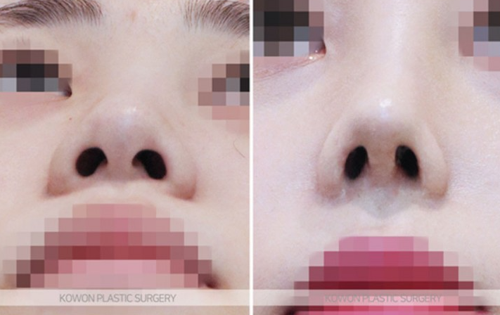 Q. Can I Have a Non-Implant Nose Surgery Along with Changes Before and After Bulbous Nose Surgery? image 7