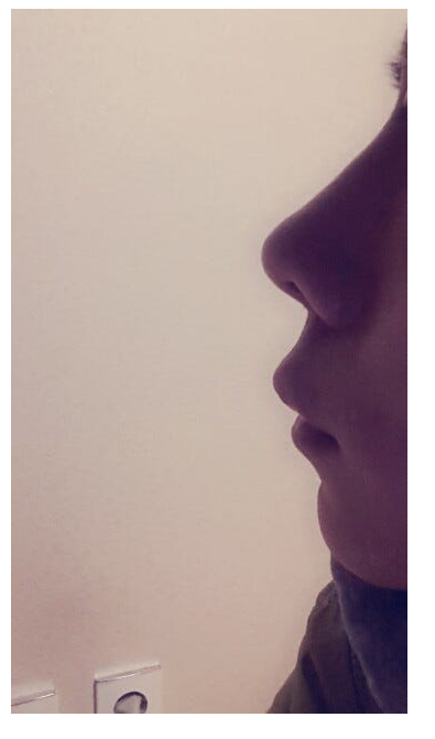 Q. My nose looks artificial because of swelling after bulbous nose surgery. Should I get revision rhinoplasty? image 3