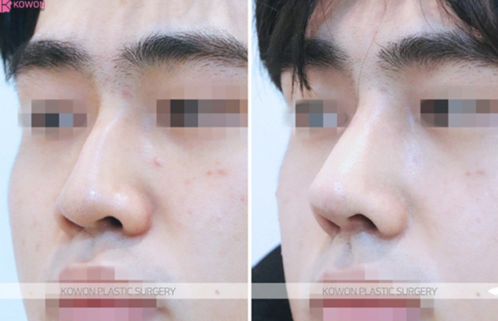 Q. Concerns After Hump Nose Rhinoplasty and Nasal Fracture Surgery: Possibility of Revision Surgery for Men image 7