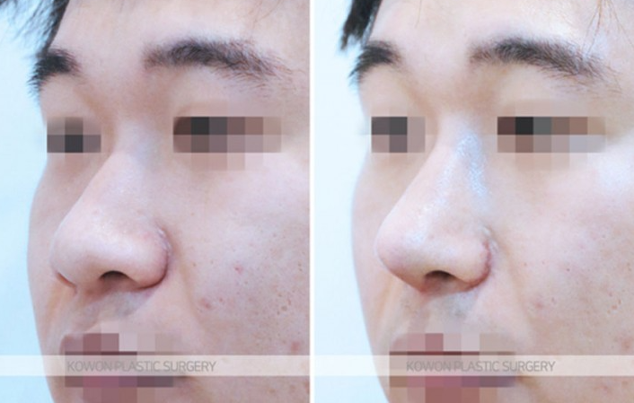 주먹코 수술 언제 자연스러워지나요? 직후 변화와 회복기간 정리 관련 이미지 7