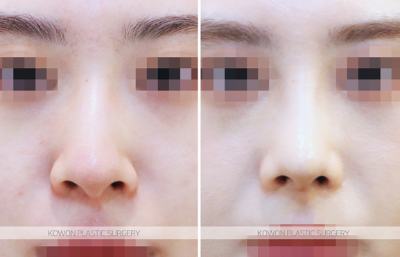 Q. Would nose fat-dissolving injections be effective? I’m wondering whether bulbous nose surgery or tip surgery is necessary image 7