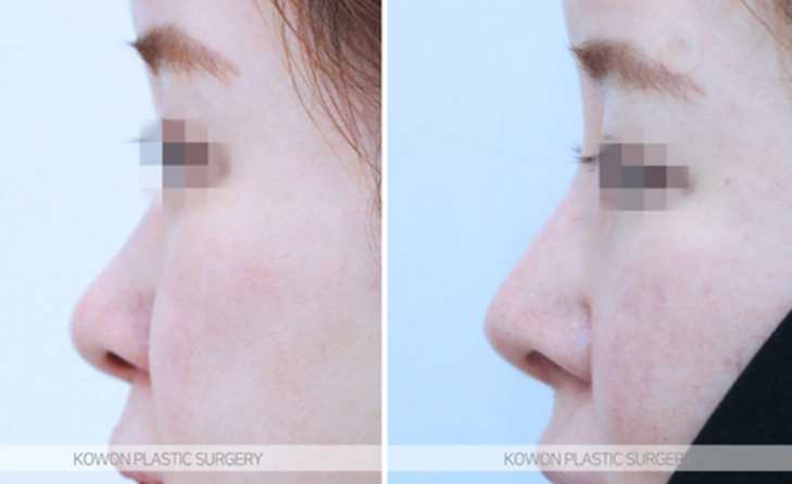 Q. Concerned about revision surgery for a long and wide nose: What is the key to natural-looking nose surgery results? image 9