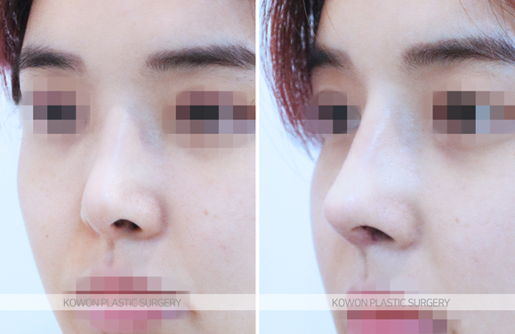 Q. Revision Rhinoplasty Clinic: Can a Crooked Nose Caused by a Bump After Nose Surgery Be Revised? image 4