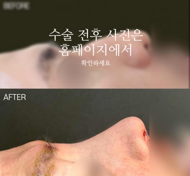 남자매부리코 교정, 비중격만곡증까지 함께 고려해야 하는 이유 관련 이미지 2