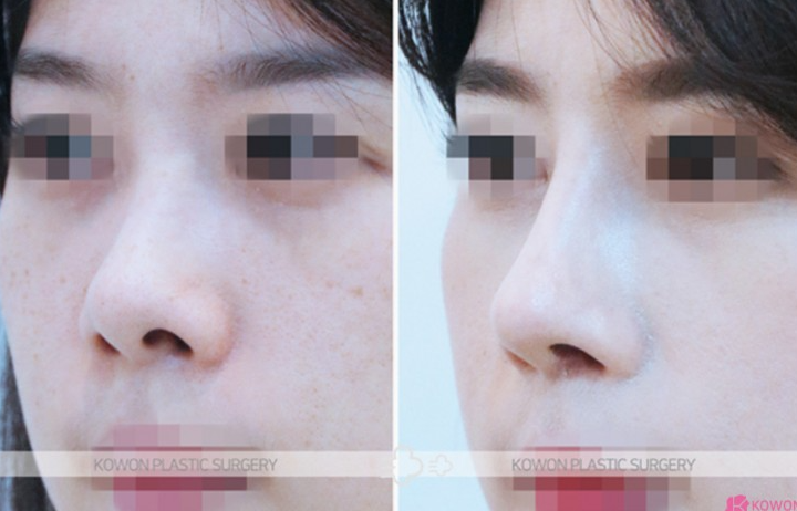 Q. After nose surgery, I can’t make a pig nose. Will removing the silicone fix it? image 6