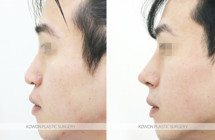 Q. After tip rhinoplasty with ear cartilage nose surgery, when does the pain from touching the nose become better? image 4