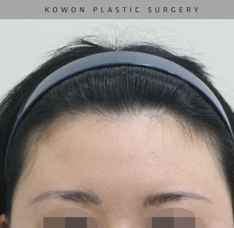 This is a review of nose surgery for a bulbous nose using donated rib cartilage at Kowon Plastic Surgery! image 19