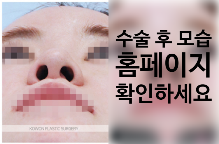 퍼진코수술 전후 입체감 비교와 코원성형외과 중안면부 개선 노하우 관련 이미지 3