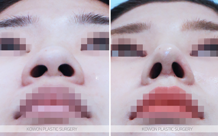 Q. Learn About Changes Before and After Alar Reduction Surgery Without Implants and Alar Reduction Surgical Methods image 8
