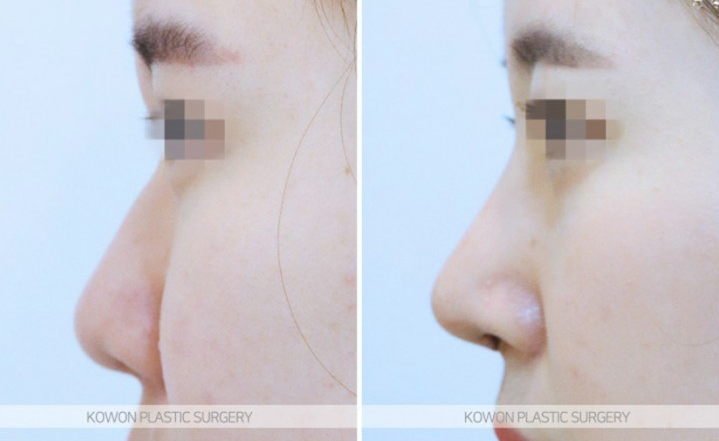 Q. Is Kangnam nose revision surgery necessary for a nose tip surgery complication? image 6