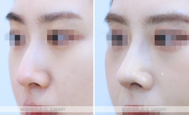 Low Nose Rhinoplasty: A Change to a More Three-Dimensional Impression, 3 Questions About Tip Cartilage Repositioning image 8