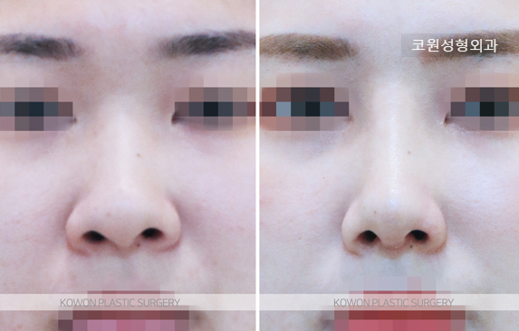 복코수술전후 코끝만 줄이기보다 미간과 콧대 흐름을 함께 보는 이유 관련 이미지 3
