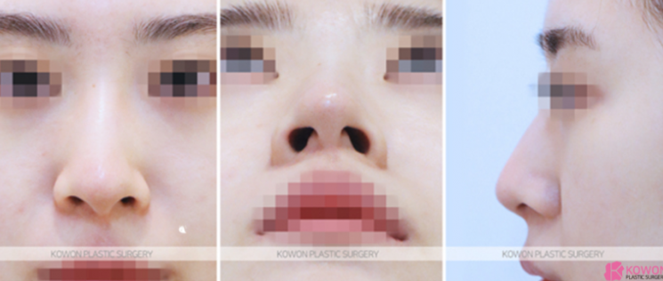 Q. I’m asking because I’m worried about complications after tip surgery and the duration of non-incisional alar reduction. image 4