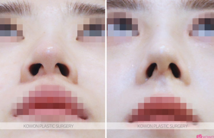 Q. Which is the right choice: nasal osteotomy or tip elevation in nose surgery? image 8