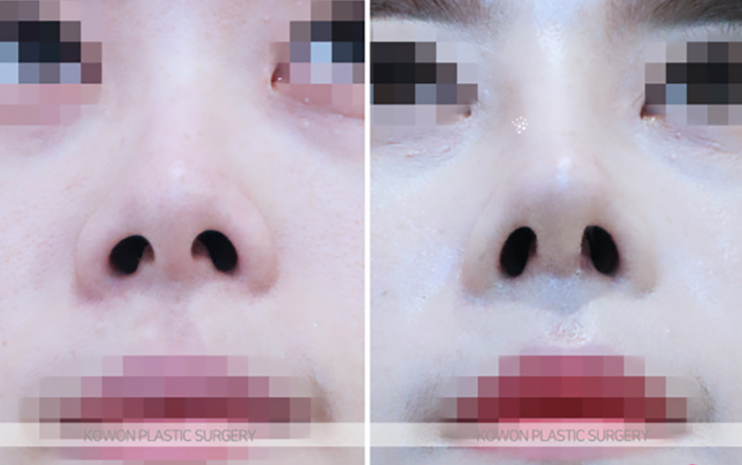 Q. Questions About Bulbous Nose Surgery and Post-Jaw Surgery Nose Surgery Answered image 7