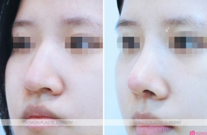 Q. 휜코수술 비대칭 코 컴플렉스, 코성형보험 되나요? 관련 이미지 4