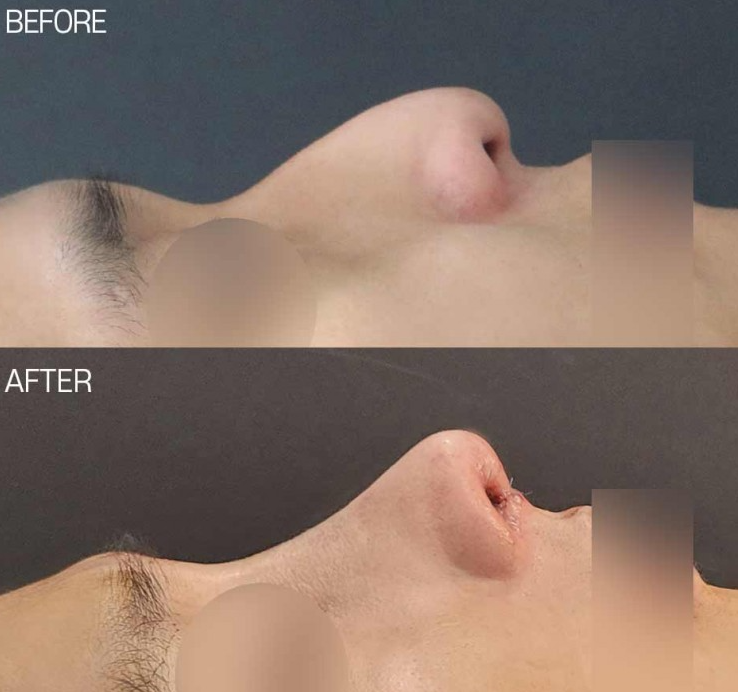 How Long Does Nose Surgery Swelling Last? A Summary of Immediate Changes and the Recovery Process image 3