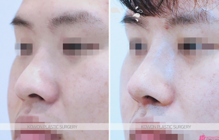 Q. Can a large nose be improved with nasal bridge osteotomy and tip surgery? (Question about male rhinoplasty before and after) image 6
