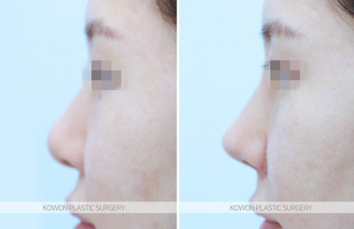 Q. 고민 about alar base surgery: do the nostrils need shape correction? image 8