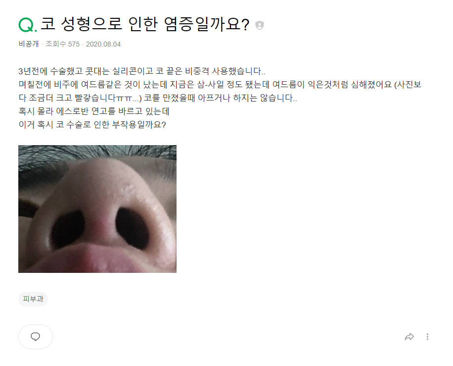 Q. Is it just a simple issue after male rhinoplasty in Gangnam? Resolving concerns about revisional surgery for nasal inflammation image 2