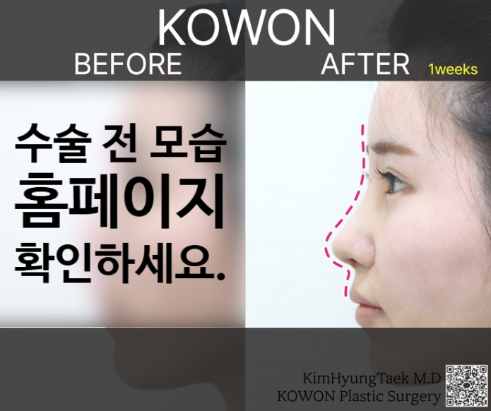 긴코성형, 매부리와 휜코까지 동시에 개선하는 코원성형외과의 노하우 관련 이미지 3
