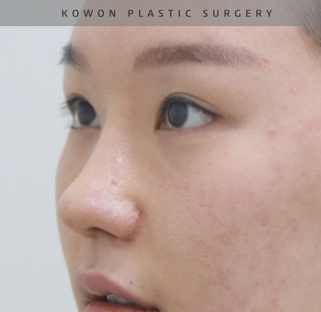 자가늑 코재수술로 비순각수술을 해서 저에게 어울리는 코를 찾았어요! 관련 이미지 10