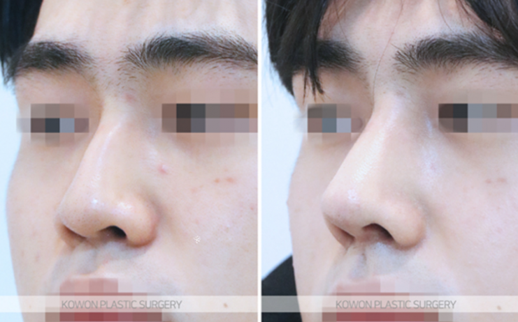 Q. The three-dimensional look that changes before and after male nose surgery: What changes are possible with male nose surgery? image 8