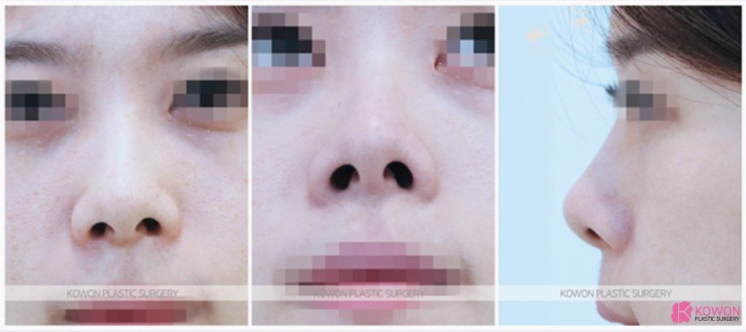 자연스러운 입체감을 완성하는 들창코 수술, 만족도를 높이는 코원성형외과의 노하우 관련 이미지 3