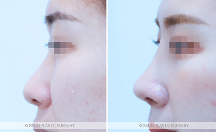 Q. I’m worried because of the difference before and after nostril reduction surgery image 10
