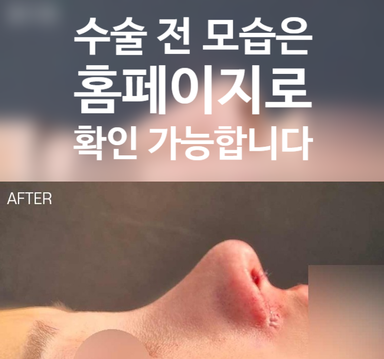 비대칭 콧대와 들린 코끝을 한 번에 잡는 휜코 수술 핵심 정리 관련 이미지 2