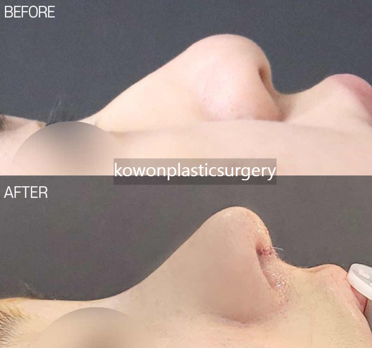 Looking at the Change Process Before and After Bulbous Nose Surgery and the Flow of Nasal Tip Structural Improvement image 2