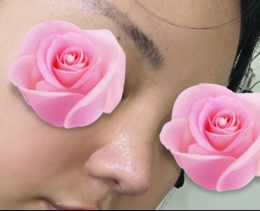 This is a review of nose surgery for a bulbous nose using donated rib cartilage at Kowon Plastic Surgery! image 6