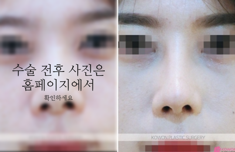 작은코성형에서 입체감 있는 코 라인을 만드는 핵심 3가지 관련 이미지 9
