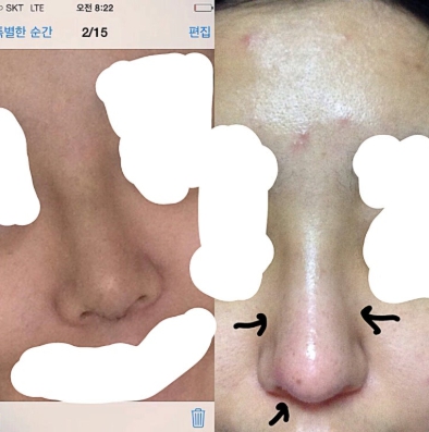 Q. Nasal Surgery Swelling: Is the Swelling on the Bridge of the Nose Due to Infection After Nose Surgery? image 3