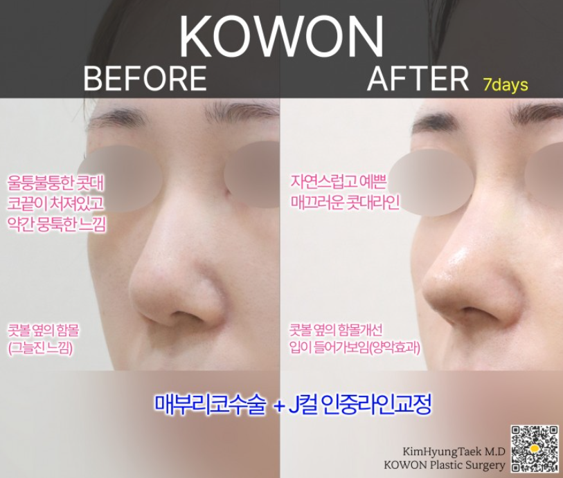 매부리코성형 전후 얼마나 차이날까? 복코와 넓은 콧볼까지 함께 고려한 변화 관련 이미지 7