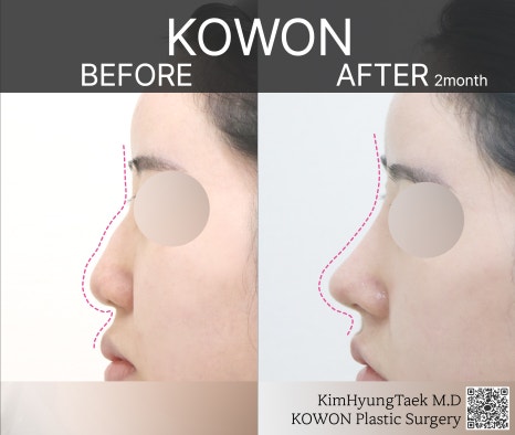울퉁불퉁해 신경 쓰이던 코를 코원성형외과에서 낮은코와 매부리코교정으로 매끄럽게 만들었어요! 관련 이미지 21
