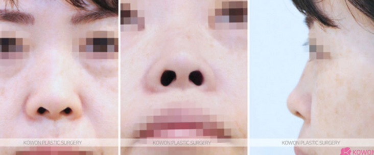 Q. I’m considering nose surgery in Seoul, and I have questions about the methods and safety of rhinoplasty image 4