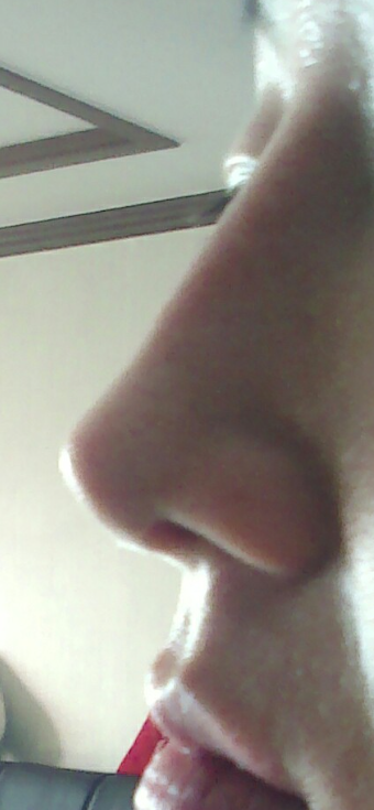 Q. After silicone nose surgery, do I need a revision if the bridge has collapsed? image 3