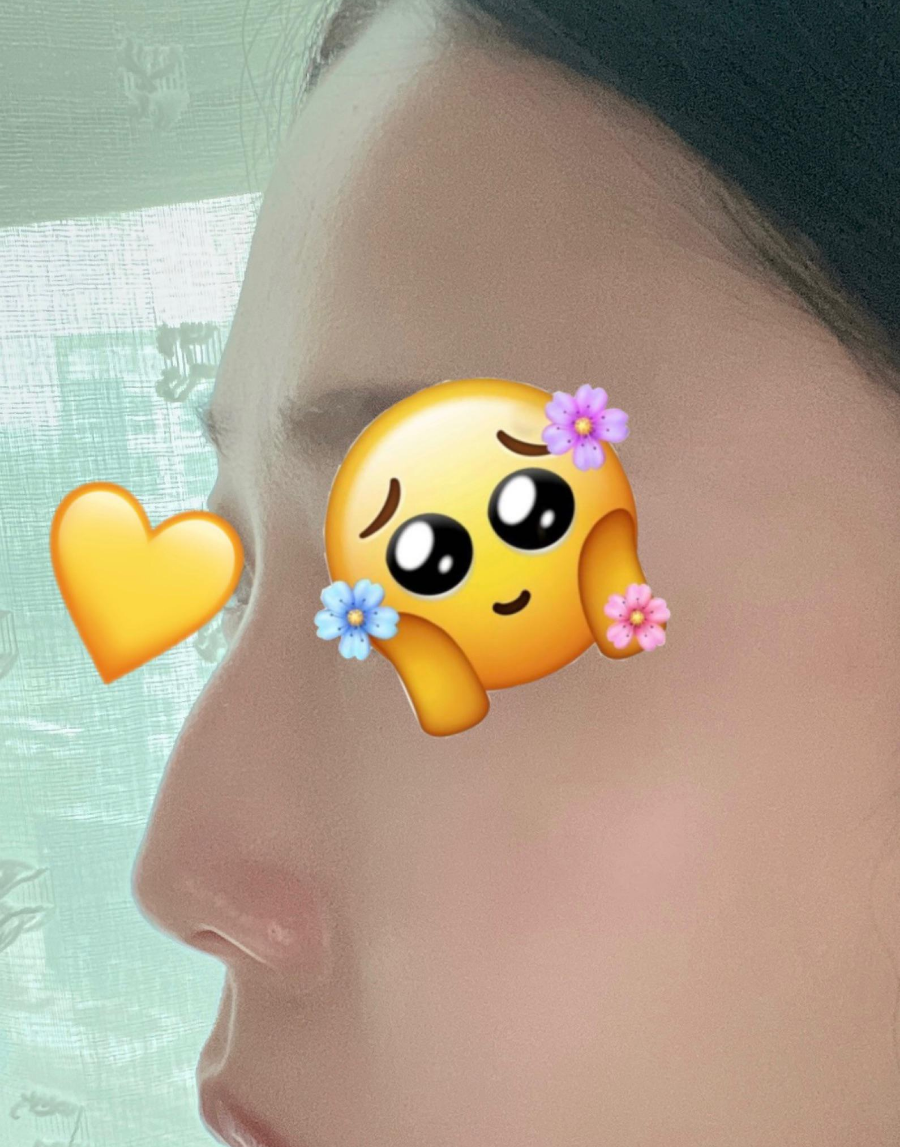 매부리코교정, 비염수술코성형까지 한번에 해결 됐어요! 관련 이미지 2