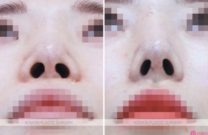 Q. I’m 고민 whether this is a side effect of cartilage nose surgery after revision rhinoplasty near Sinsa Station image 8
