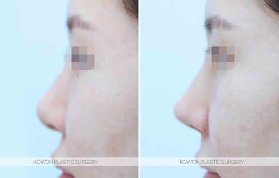 Looking at the Change Process Before and After Bulbous Nose Surgery and the Flow of Nasal Tip Structural Improvement image 9
