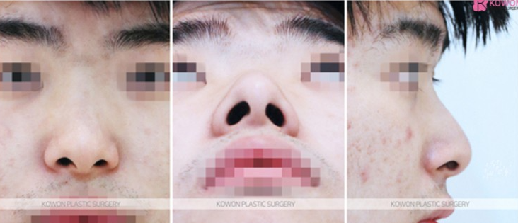 Q. Is it just a simple issue after male rhinoplasty in Gangnam? Resolving concerns about revisional surgery for nasal inflammation image 4
